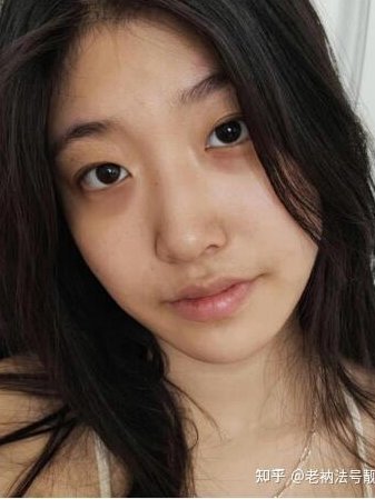 黑眼圈成因揭秘：遗传、衰老与健康隐患